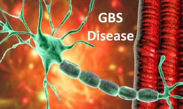 GBS : जीबीएस या दुर्मिळ आजाराची लक्षणे, निदान, उपचार